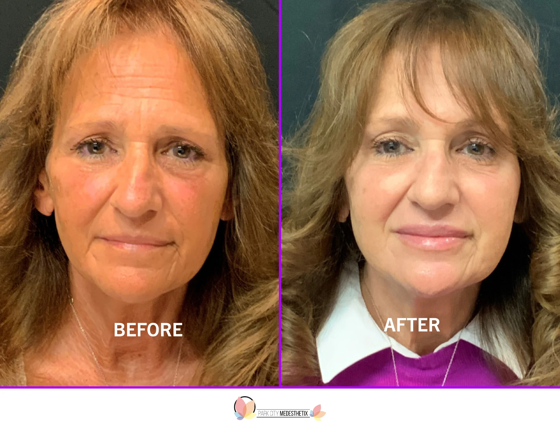 Anti-aging results Park City