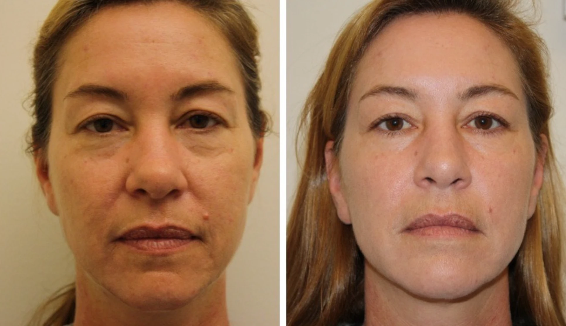 Wrinkle Reduction Park City