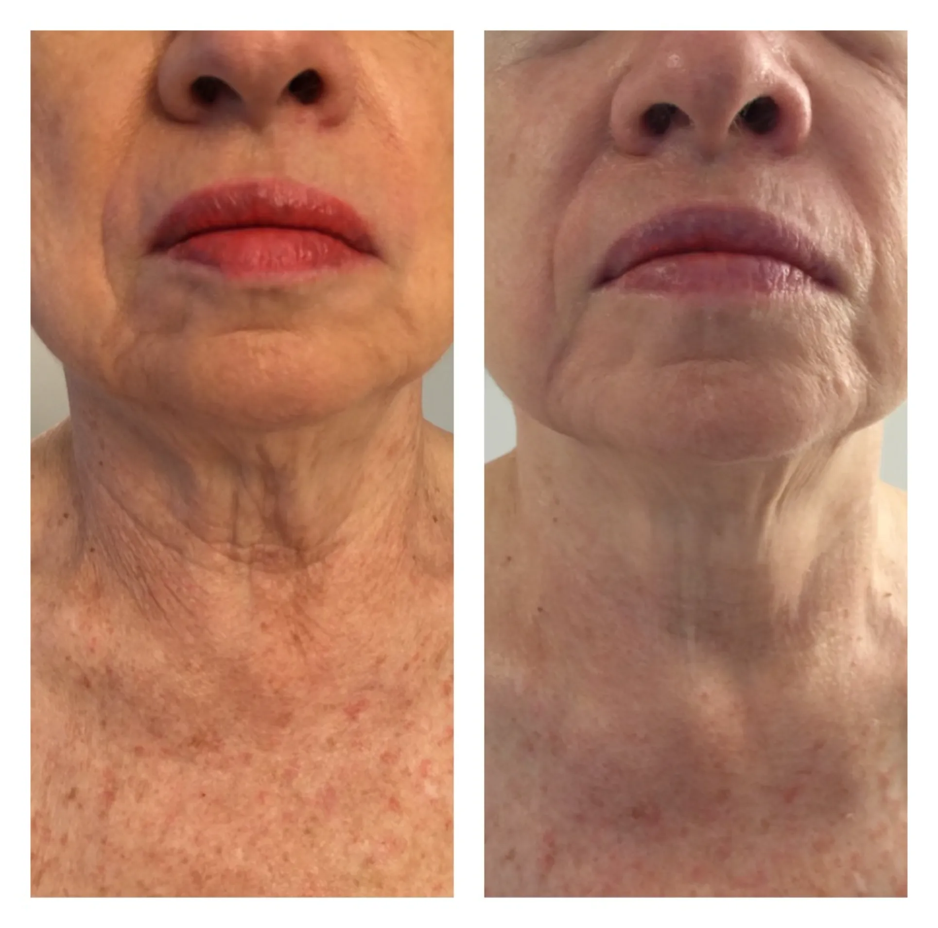 Skin Tightening Park City