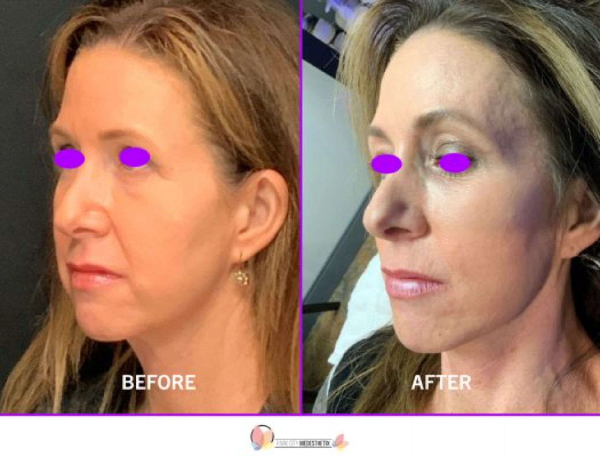 Wrinkle Reduction Park City