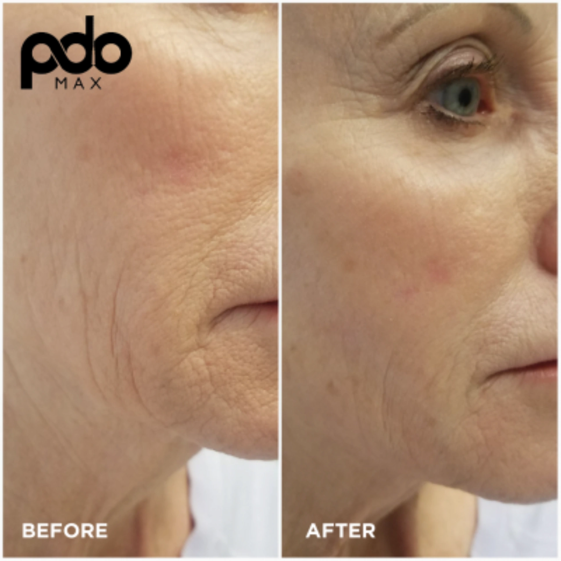 PDO Threadlift Body