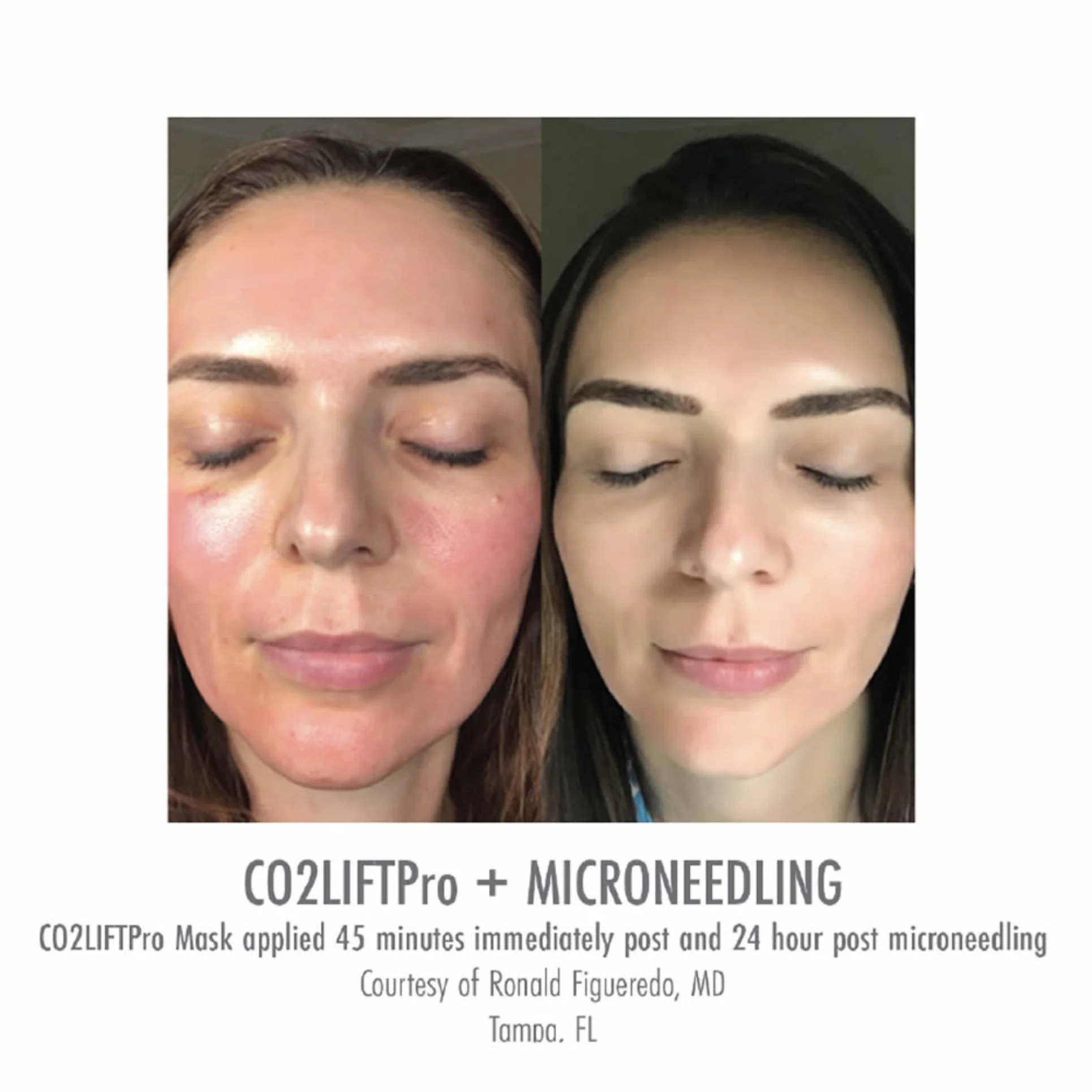 CO2 Lift Pro Park City