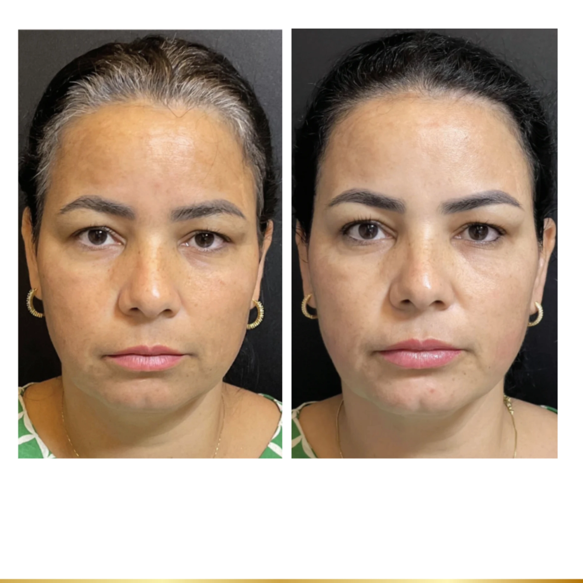 Front view comparison of woman’s face before and after skin rejuvenation with smoother, more radiant complexion after mesoneedling treatment