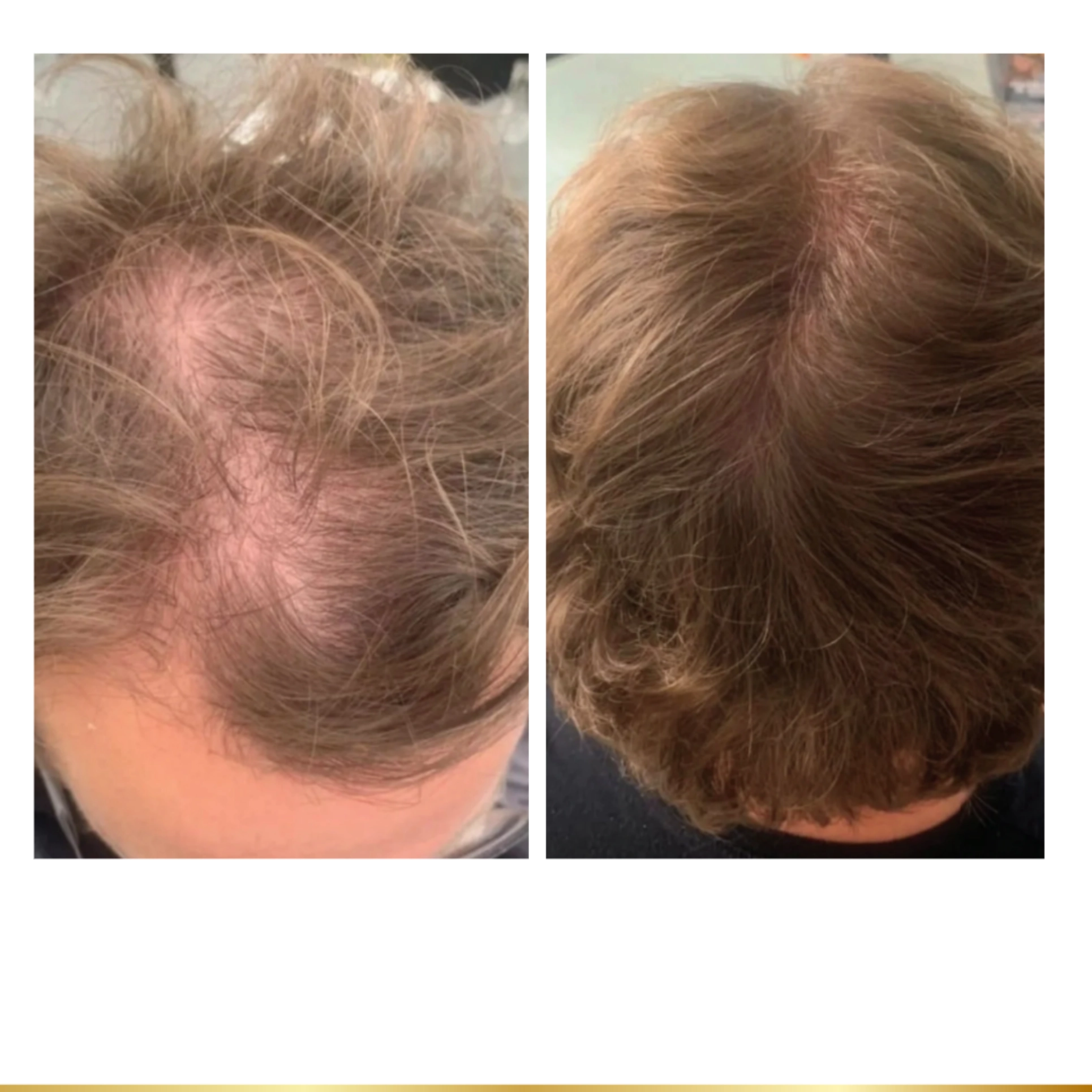 Thinning hair before treatment and fuller hair after.